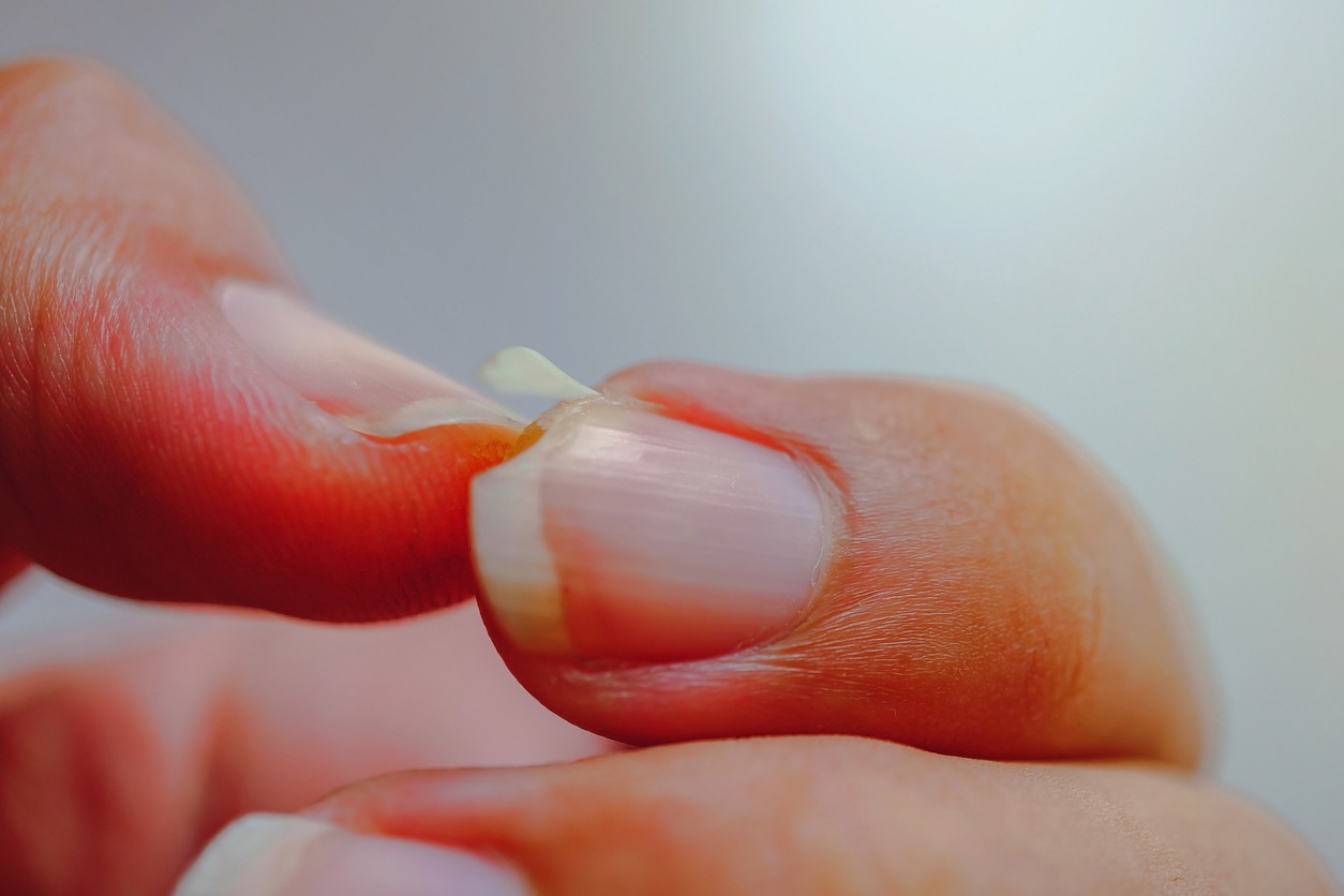 Cracked nails