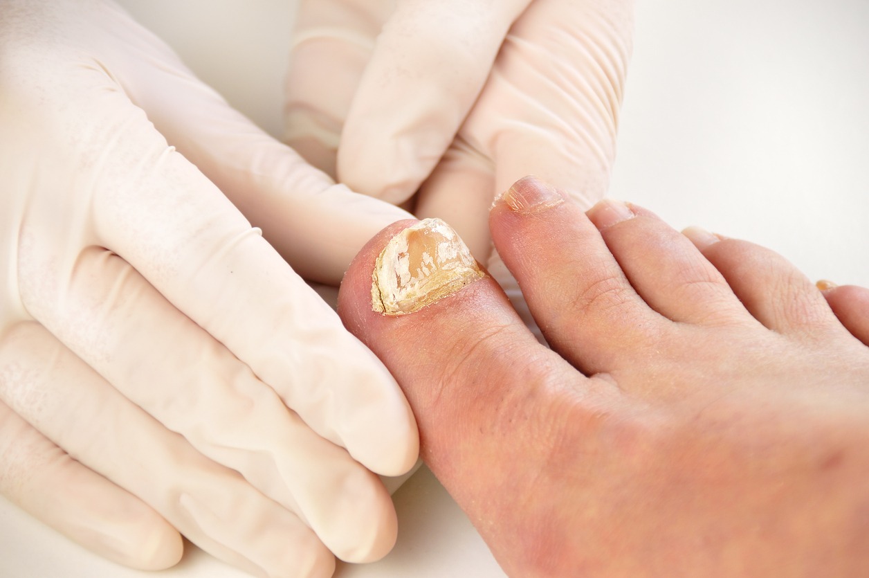 Toenail infected with fungus