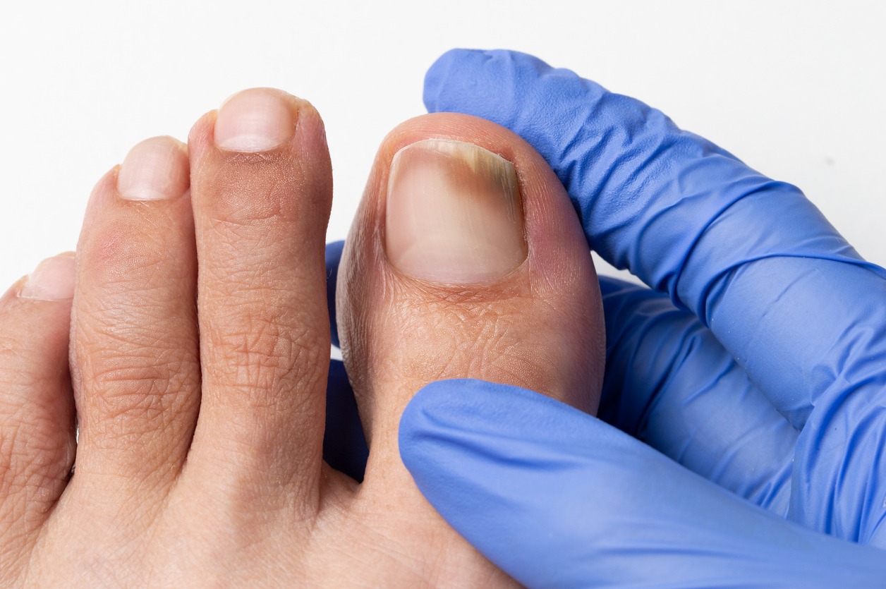Toenail trauma