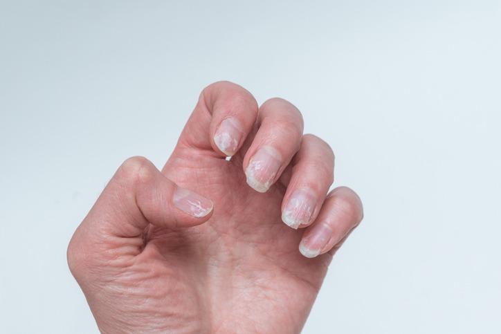 Bitten and broken nails without manicure with overgrown cuticle of nail and a damaged nail plate after applying gel polish