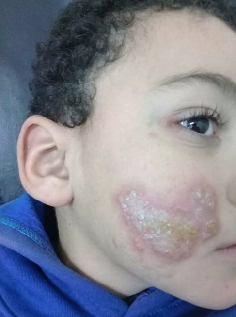 rashes on a baby’s cheek