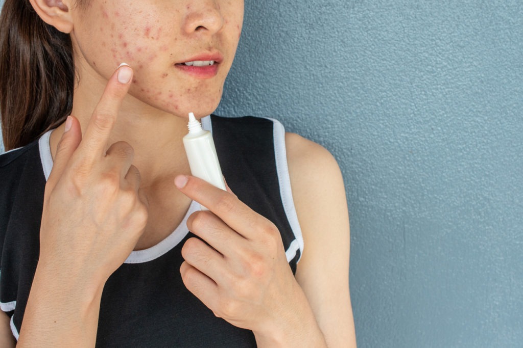 Portrait of woman with acne inflammation (Papule and Pustule) on her face and she trying to applying acne cream on her face for treat
