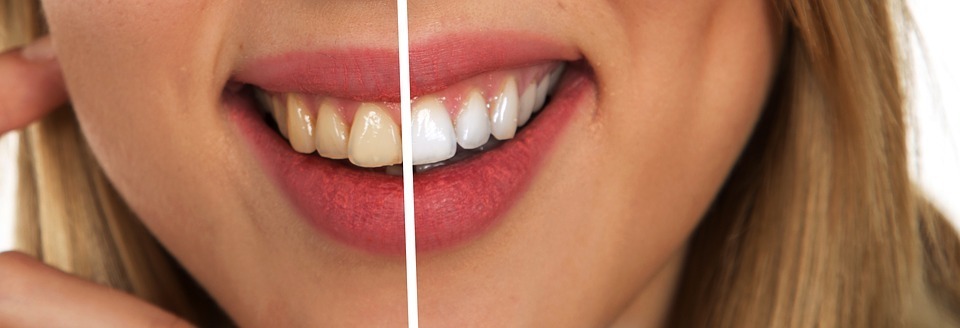 after and before picture of using a teeth whitening kit