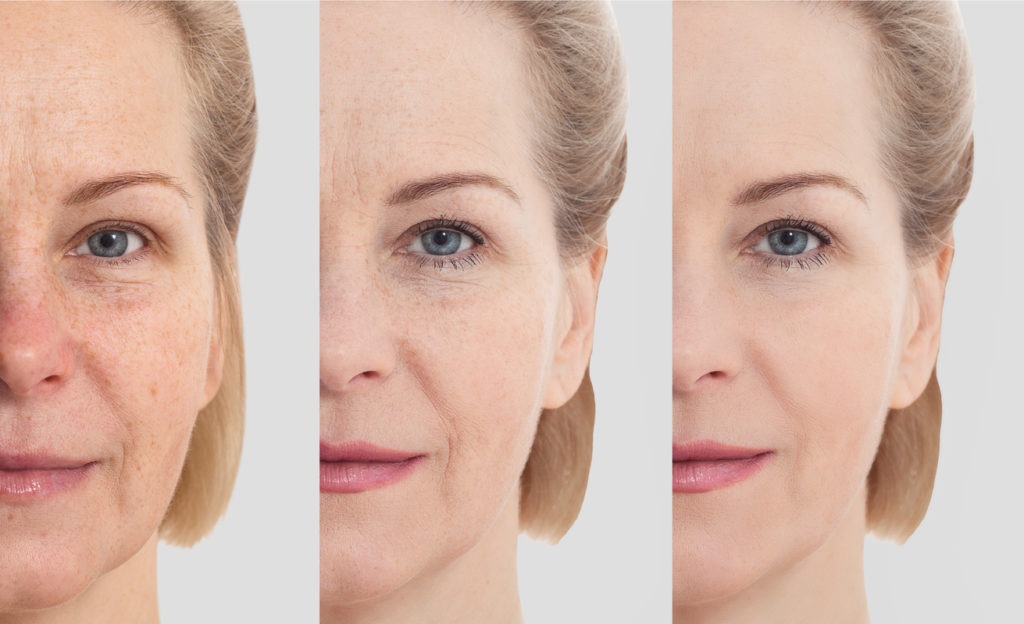 Face without makeup. Middle age close up woman face before after cosmetic. Skin care for wrinkled face. Before-after anti-aging facelift treatment. Facial skincare and contouring