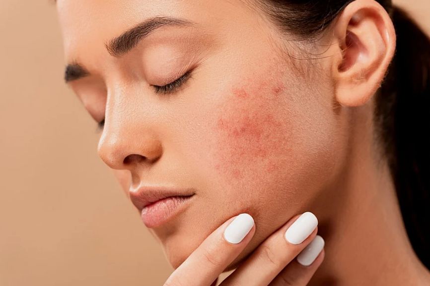 A woman with acne