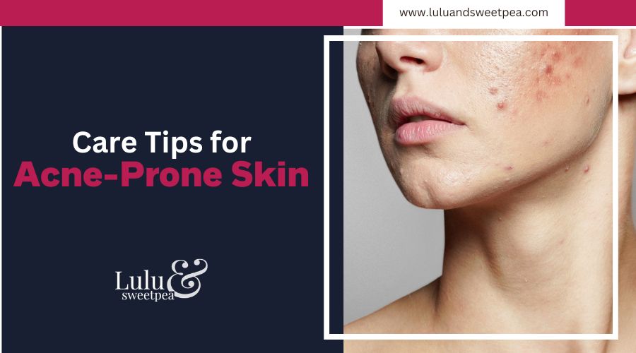 Care Tips for Acne-Prone Skin