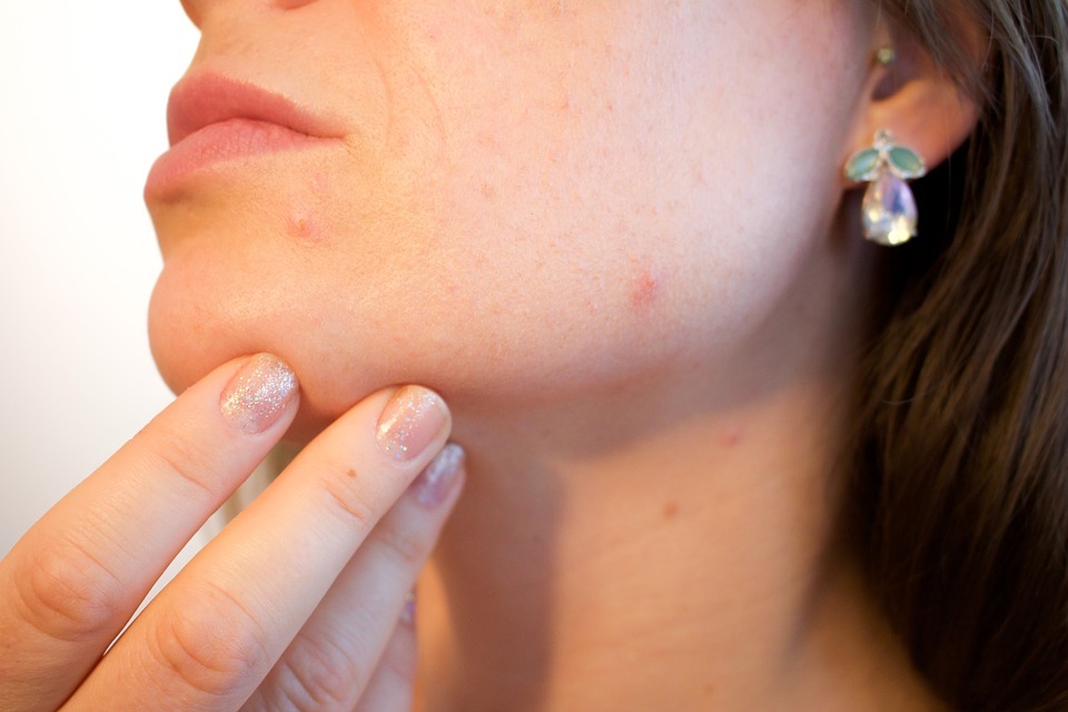 5 Tips to Get the Best Effect When You Buy Best Acne Treatment