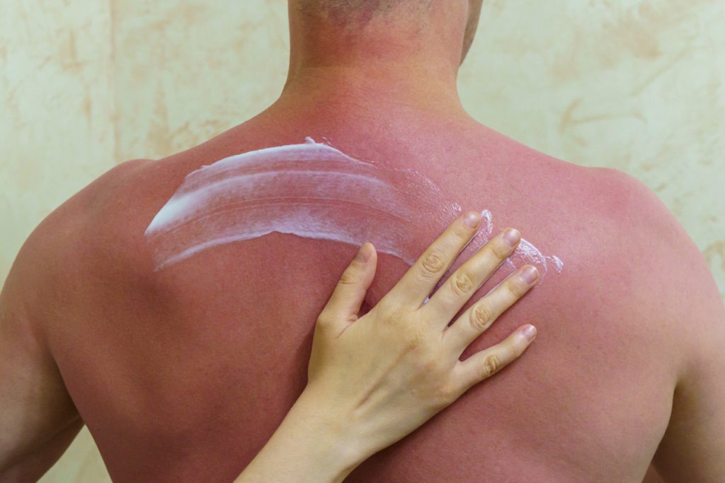 A woman's hand delicately treats a man's back, which has been scorched by the sun. 