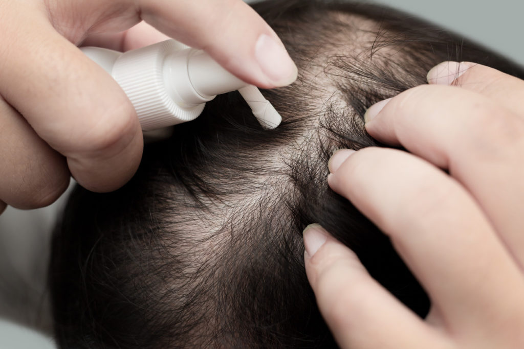 Male hand applying medication to the scalp in order to treat alopecia, hair loss, dandruff, or another hair issue.