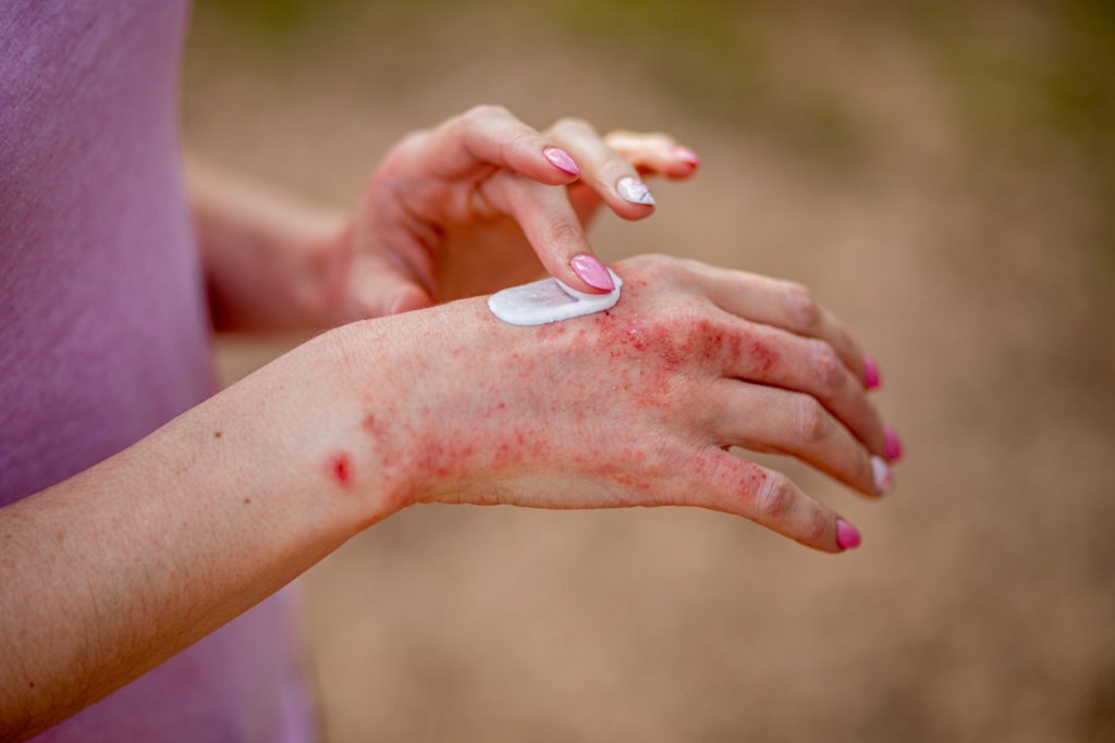 The woman is using lotions and ointments to treat psoriasis, eczema, and other skin conditions. 