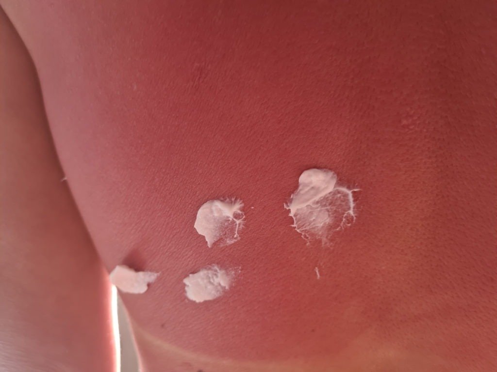 Red tan on back or allergies and cream. People with reddened itchy skin after sunburn
