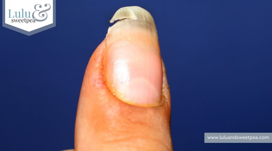 A broken nail. Lack of vitamins and calcium in the body
