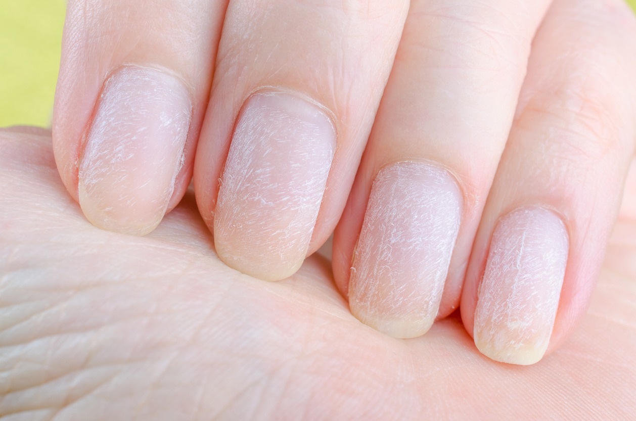 Damaged nails after removing modern gel nail polish